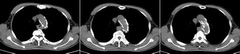 Frontiers Case Report A Case Of Rectal Metastatic Squamous Cell