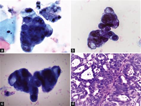 Hyperchromatic Crowded Groups Hcg In Pap Smears Cytojournal