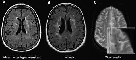 Small Blood Vessel Disease Cerebral Changes Brain Mri Resonance Matter