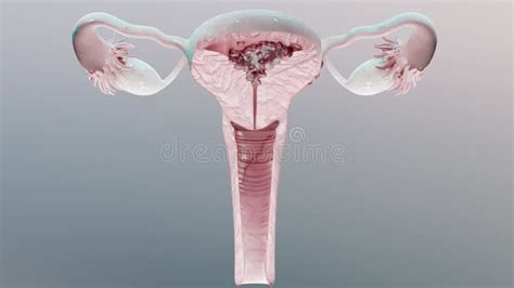 Uterus Malignant Tumor Female Uterus Anatomy Reproductive System