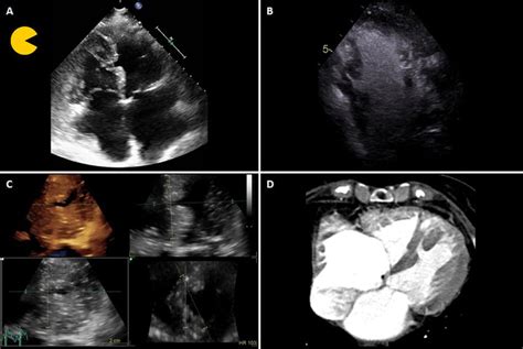 A Transthoracic Echocardiogram TTE Showing A Partial Loss Of