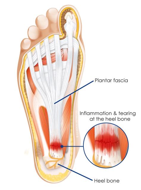 Plantar Fascia - Advance Family Chiropractic & Massage Therapy