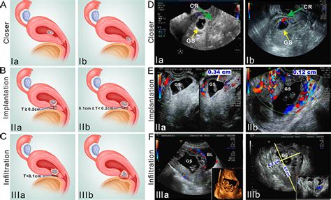 Cesarean Scar Pregnancy Classification Evaluation System Ijgm