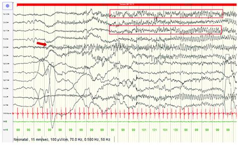 The Long Term Video Electroencephalographic Monitoring V Eeg Ltm