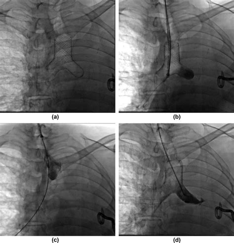 Removal Of Covered Metallic Stents With A Bullet Head For