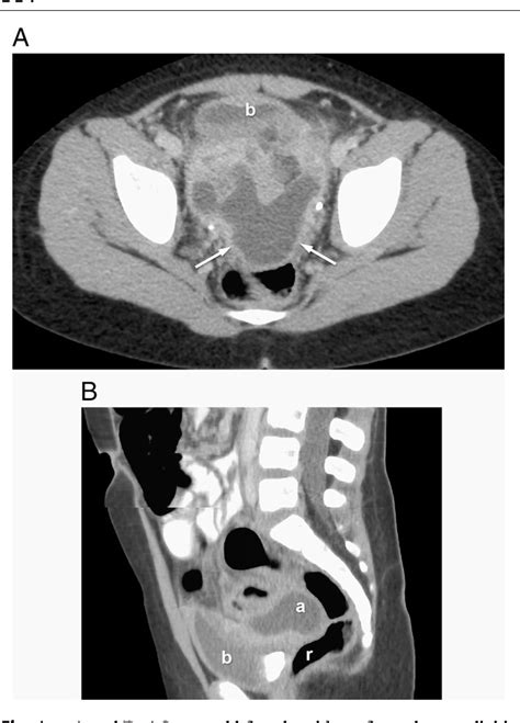 Figure 1 From Transrectal Ultrasound And Fluoroscopy Guided Drainage Of