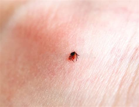 A Tick Embedded In A Person Skin Stock Image Image Of Causing