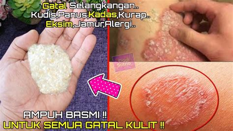 Gambar Kurap Pada Kulit Penyakit Kulit Yang Muncul Saat Musim Hujan