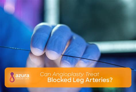 Angioplasty Procedure and PAD | Treat Blocked Leg Arteries