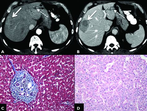 Hepatocellular Carcinoma In Chronic Hepatitis C In The Absence Of Advanced Fibrosis Or Cirrhosis