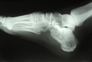 Diagnostic Imaging Of The Foot And Ankle For Physical Therapists