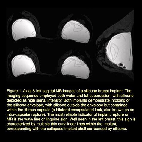 MRI BLOG MRI Of Silicone Breast Implant