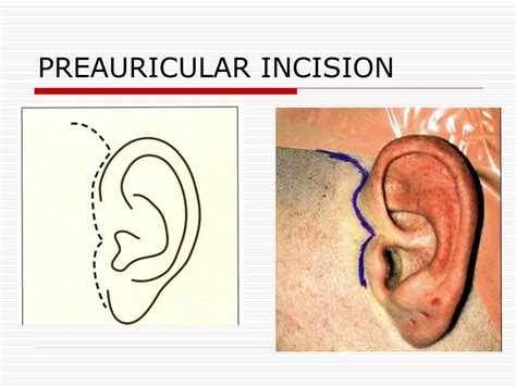 Ppt Temporomandibular Joint Powerpoint Presentation Free Download