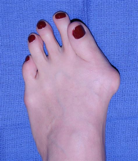 Bunion Dr Moy S Painless Bunion Surgery