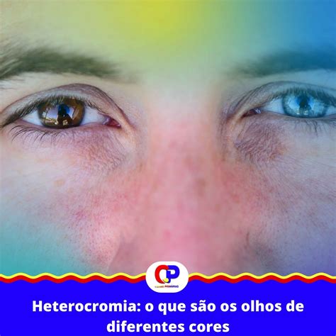 Heterocromia o que são os olhos de diferentes cores