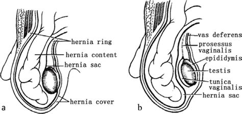 A Congenital Indirect Inguinal Hernia And B Acquired Indirect Download Scientific Diagram