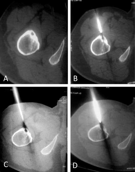 Axial Mdct Of A Different Patient Showing The Nidus And How Is The Ct Download Scientific