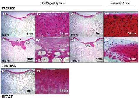 Cartilage repair tissue at 8 weeks postoperatively. Improved bone ...