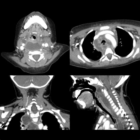 Pediatric Retropharyngeal Abscess | Pediatric Radiology Reference ...