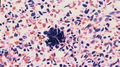 Adrenal Gland Cytology Case 9 Visceral Histoplasmosis