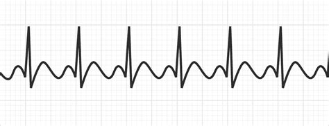 Atrial Flutter Tachyarrhythmias MedSchool