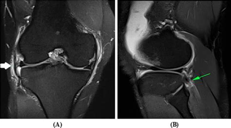 Lateral Collateral Ligament Knee Injury Statpearls Ncbi Bookshelf