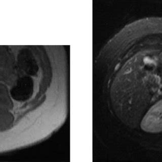 A 57 Year Old Man With Biopsy Proven Pancreatic Neuroendocrine Tumour