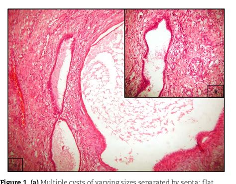 Figure 1 From Mixed Epithelial And Stromal Tumor—adult Cystic Nephroma