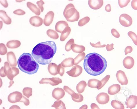 Hairy Cell Leukemia Variant 2