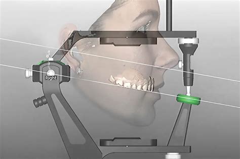 Articulateur Virtuel Technologie Laboratoire Dentaire Laval Lafond