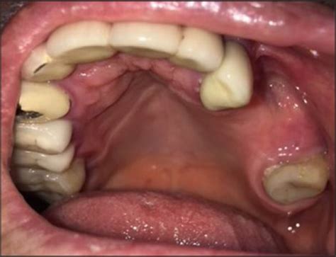 Denosumab Related Osteonecrosis Of Jaw A Case Report PMC