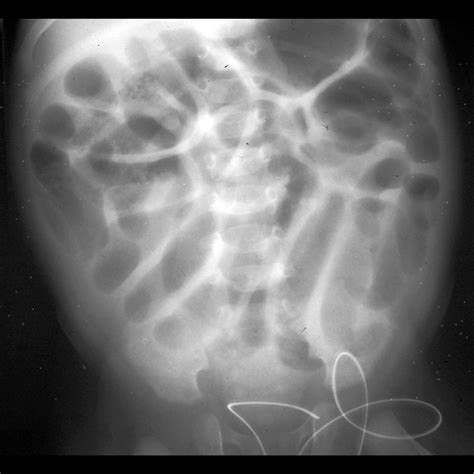 Intestinal Malrotation Pacs