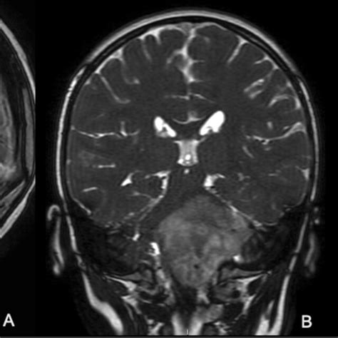 Post Operative Brain Mri Disclosed The Stoma Opening Through The Third Download Scientific