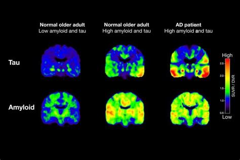 US scientists have shown it is possible to spot when Alzheimer's disease emerges through brain ...