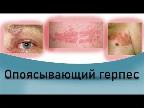 Оперізуючий герпес: що це таке, симптоми, причини та лікування ...