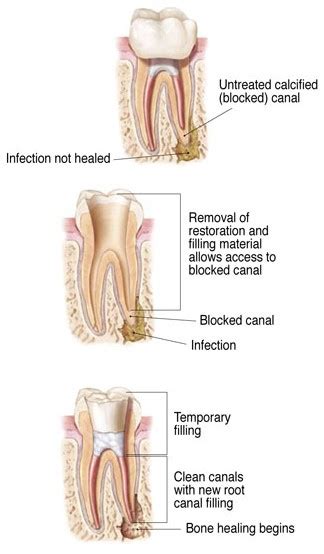 Richmond TX Root Canal Retreatment | Aliana Root Canal Therapy