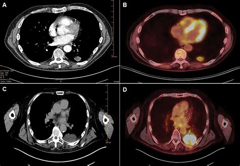 Figure 1 Rapid Sarcomatoid Transformation Of Lung Squamous Cell