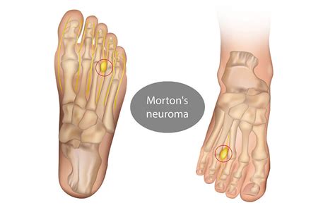 Das Morton Neurom ATOS Thema