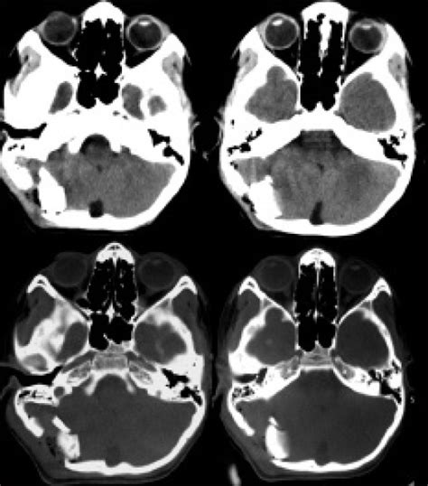 Posterior Cranial Fossa Depressed Fracture Abstract Europe PMC