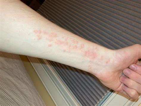 Does This Look Like Brown Tail Moth Rash R Maine