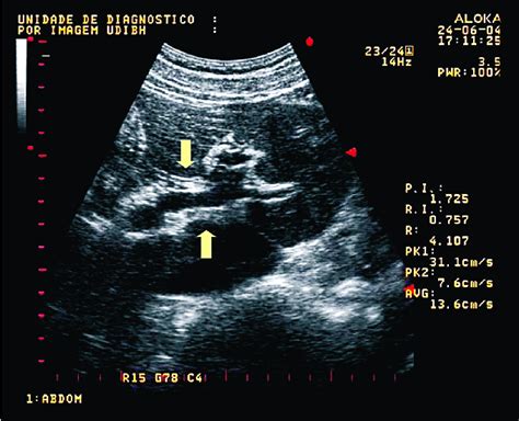 ultrasound of the abdomen showing enlarged central periportal bands... | Download Scientific Diagram