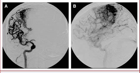 Figure 4 from Intraventricular Hemorrhage Secondary to Intranidal ...