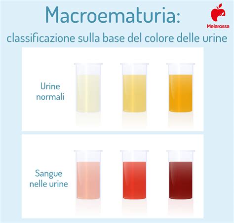 Sangue Nelle Urine Cos Cause E Rimedi Dell Ematuria