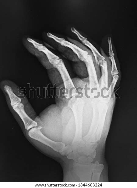 Xray Adults Hand Bone Anatomy Stock Photo 1844603224 Shutterstock