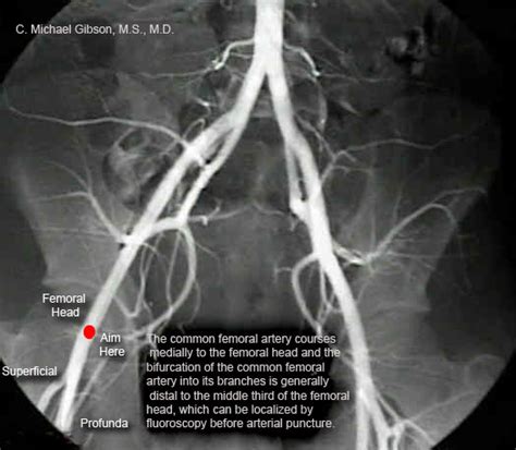 Femoral Artery Surface Anatomy