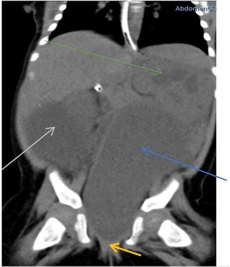 Hypodense Mass Arising From The Uterus Blue Arrow Connected To The Download Scientific