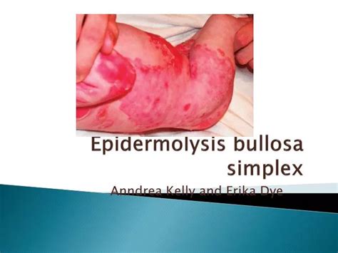 PPT - Epidermolysis bullosa simplex PowerPoint Presentation, free download - ID:2762520