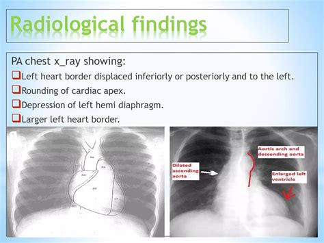 Left Ventricular Enlargement Radiology Ppt