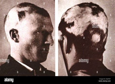Circular Alopecia Hi Res Stock Photography And Images Alamy