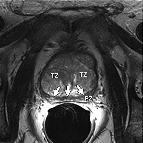 Use Of Mri For Lobar Classification Of Benign Prostatic Hyperplasia Potential Phenotypic